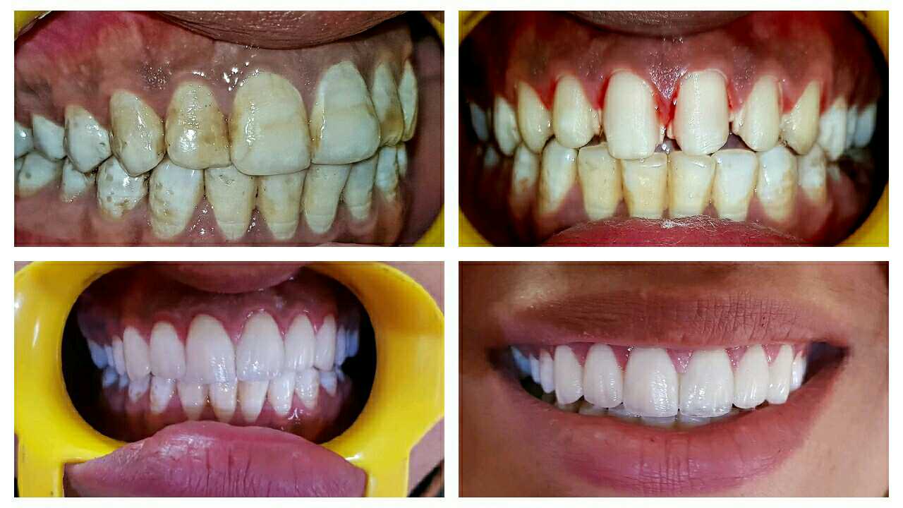 teeth whitening clinic