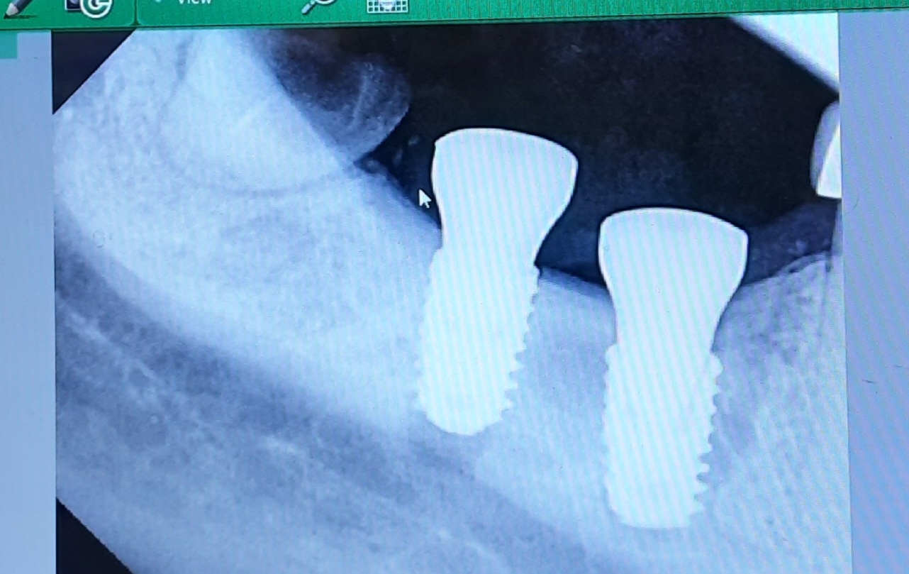 Natural Looking Dental Implants