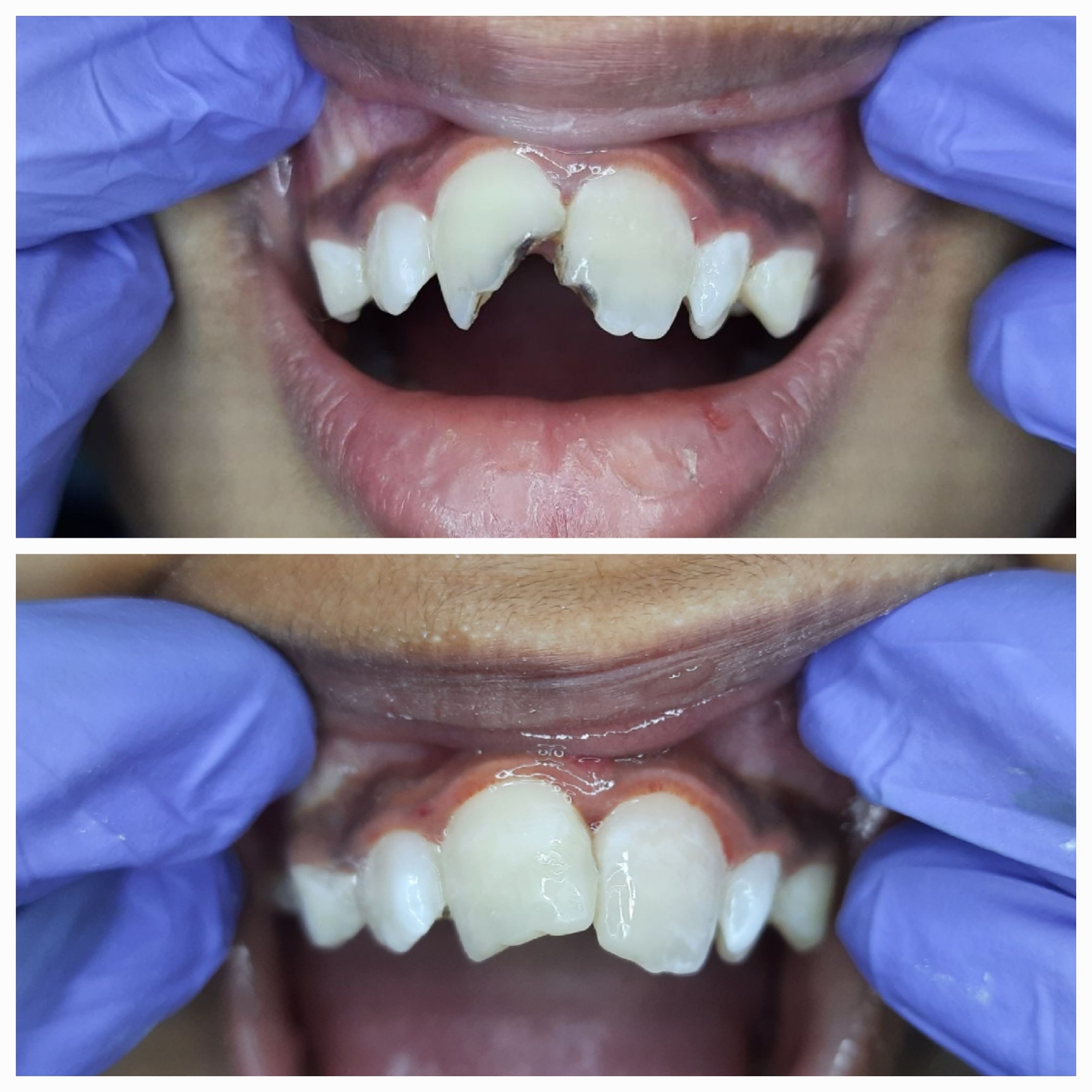 Chipped or broken tooth repair