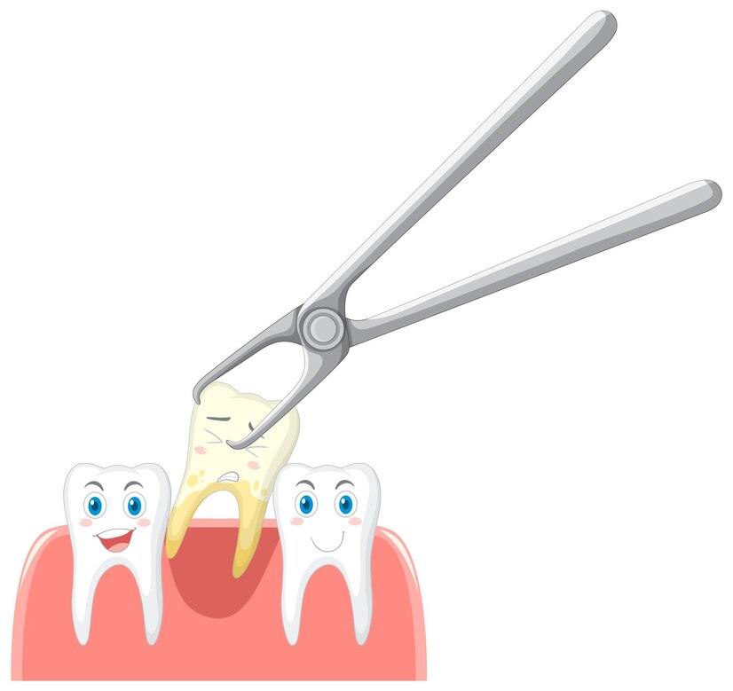 Wisdom Tooth Extraction