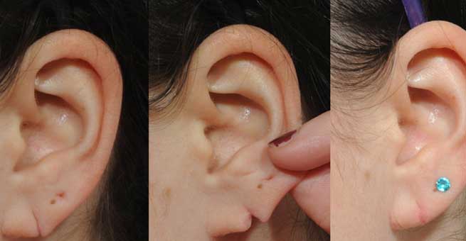 Earlobe Repair Treatment