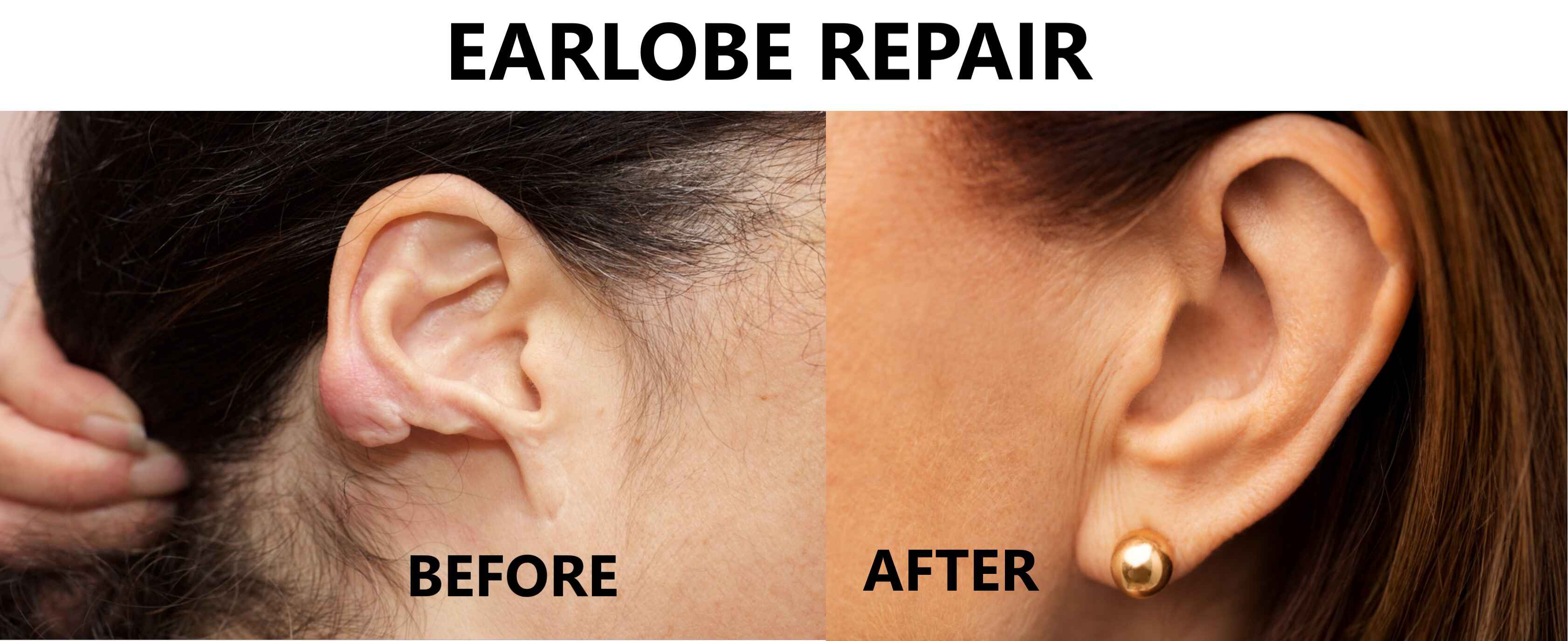 Earlobe Repair